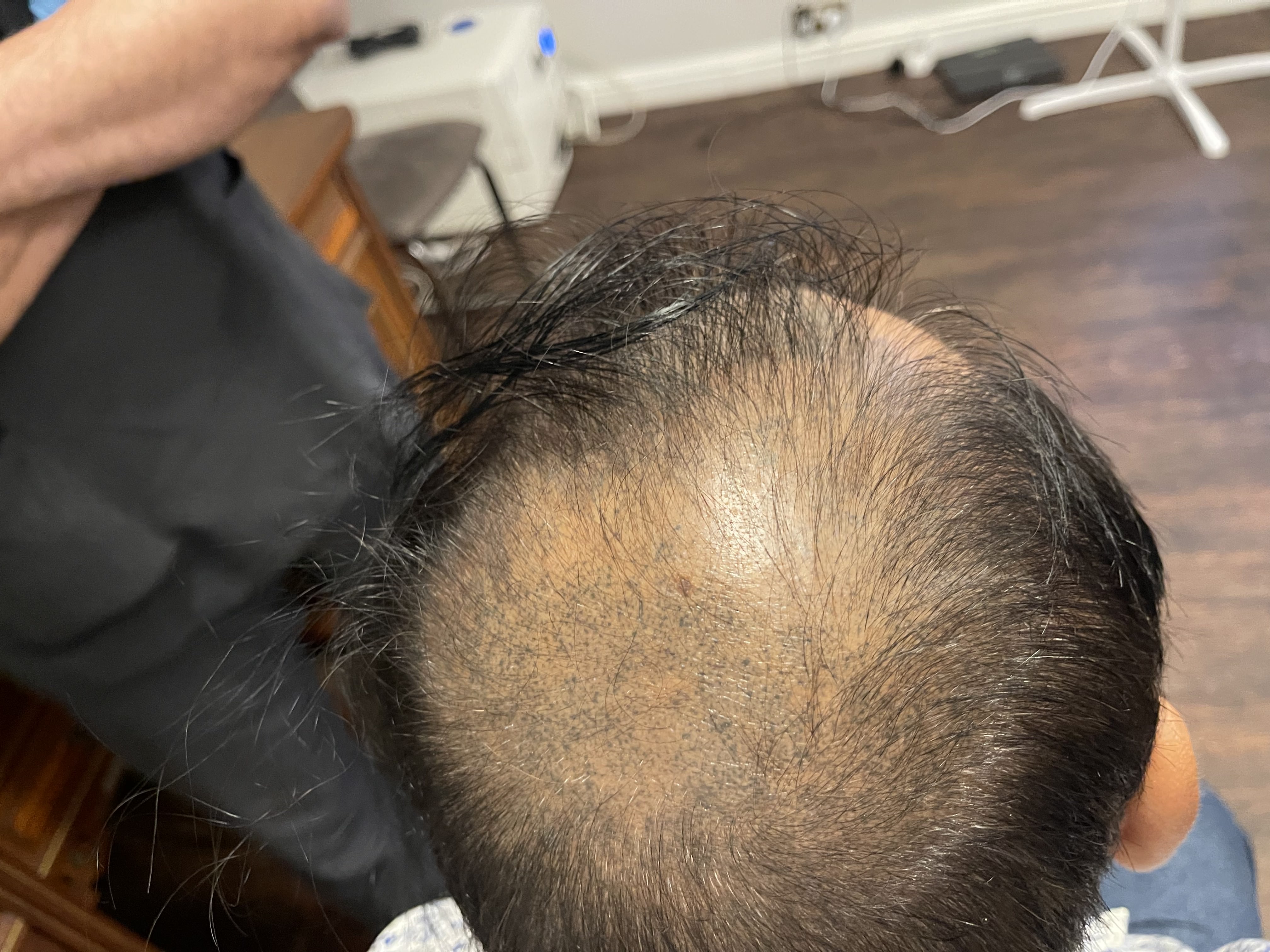 Nishant hair transplant result photo 2